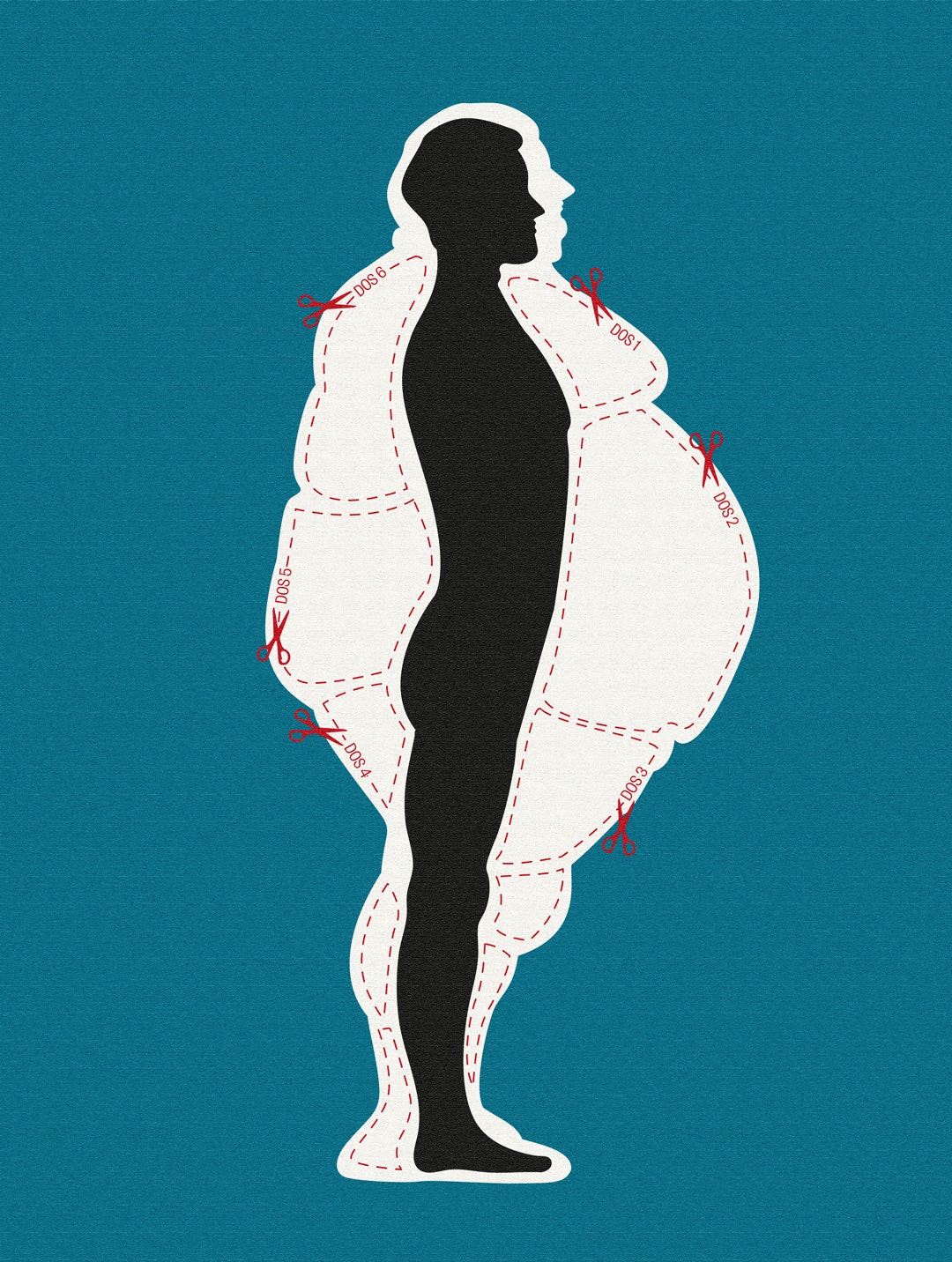 Illustration av en persons kroppssiluett med streckade linjer och saxar som markerar var kroppsfett kan opereras bort, som mönster på ett klädesplagg.